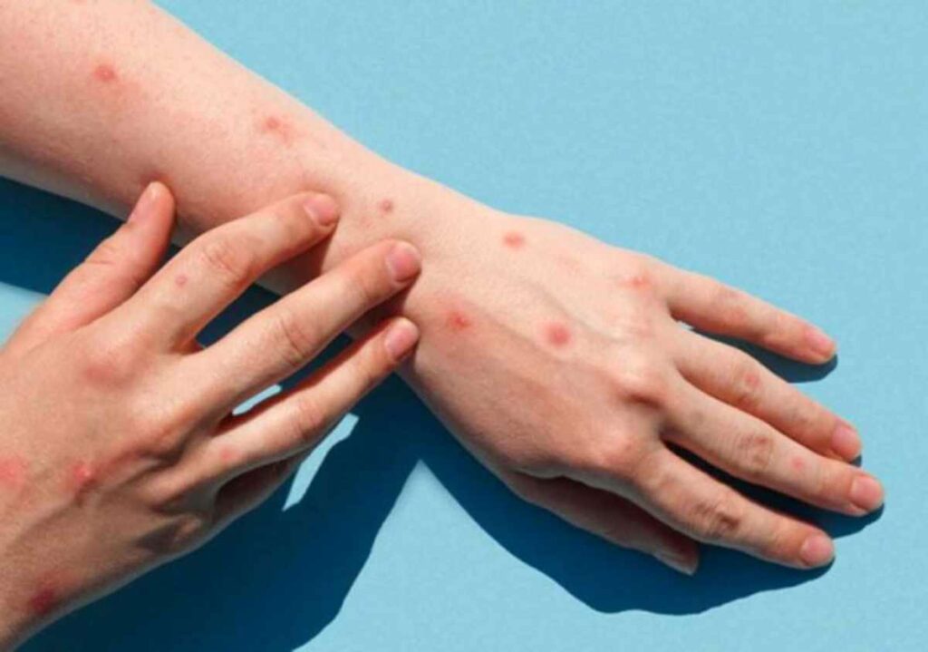 La Organización Mundial de la Salud (OMS) advirtió de la amenaza que supone el mpox (antes conocida como 'viruela del mono'). Foto: AFP