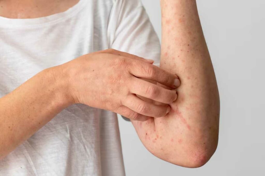 La OPS tomó esta decisión después de detectar “la transmisión de la misma cepa del virus del sarampión en Canadá durante un periodo de más de un año”